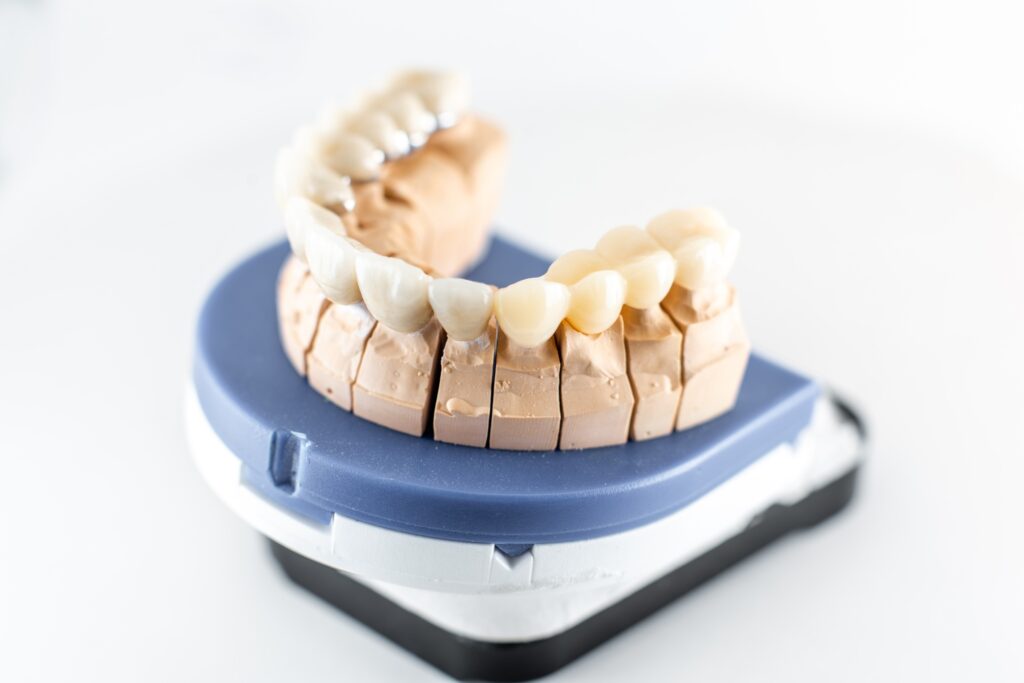 Dental imprint with artificial teeth